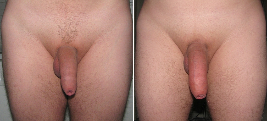 Половой член без эрекции