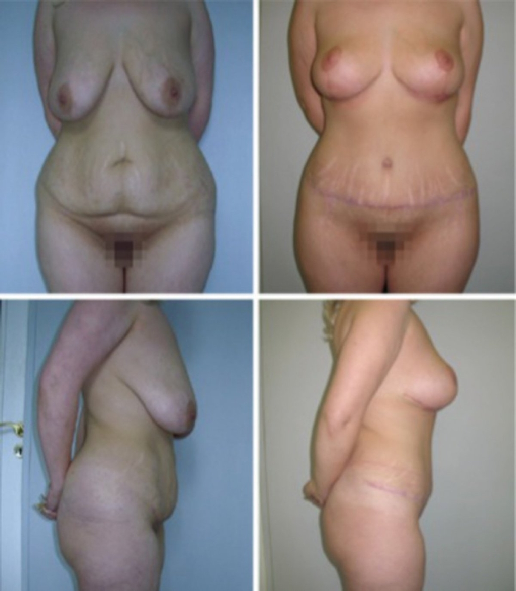 Грудь женщины после родов