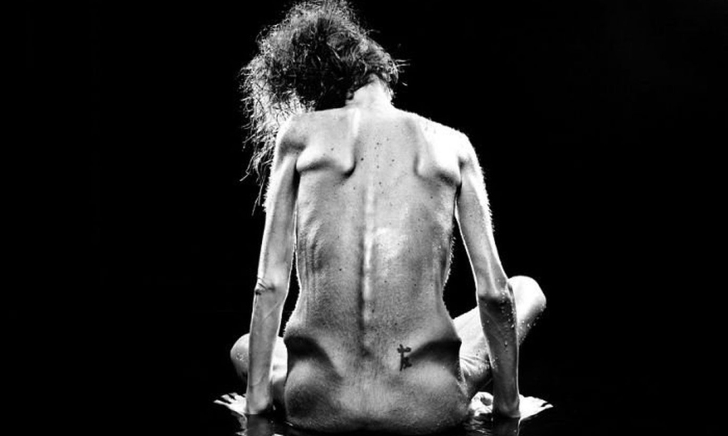 Дисморфоманическая анорексия