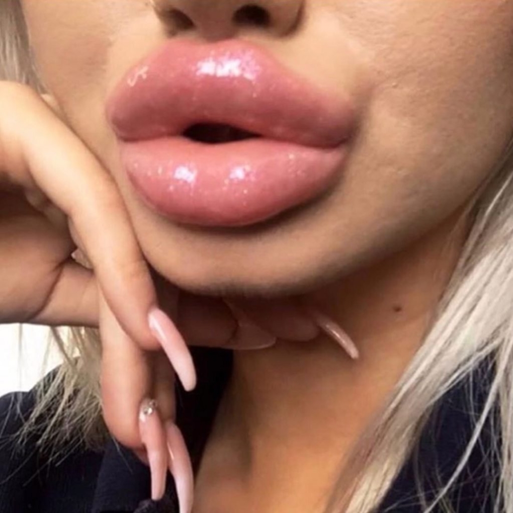 Огромные губы с ботоксом